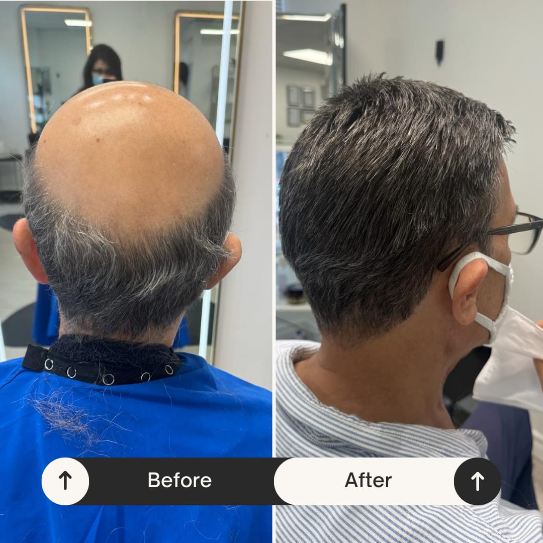Non Surgical Hair Replacement Before and after