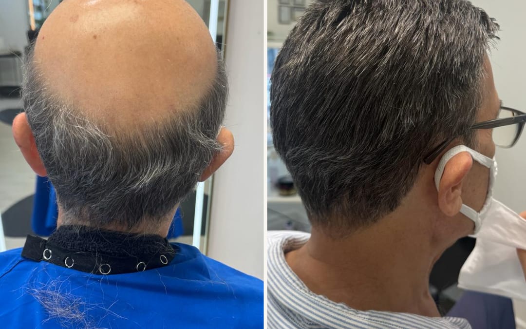 Non Surgical Hair Replacement System Before and after