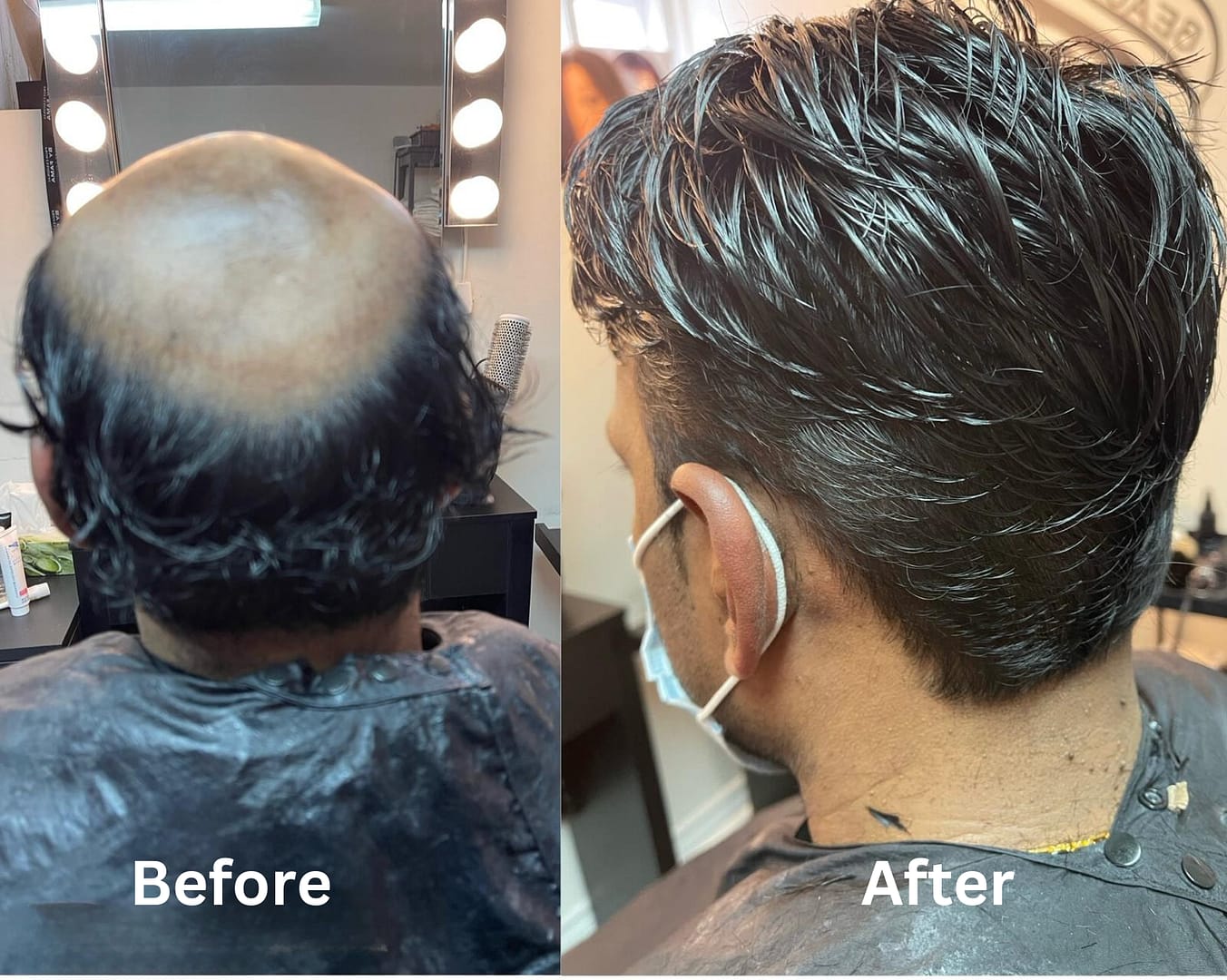 Non surgical hair replacment Beforeand after