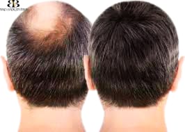Thin Skin Hair Systems and Non-Surgical Hair Grafts<br />
